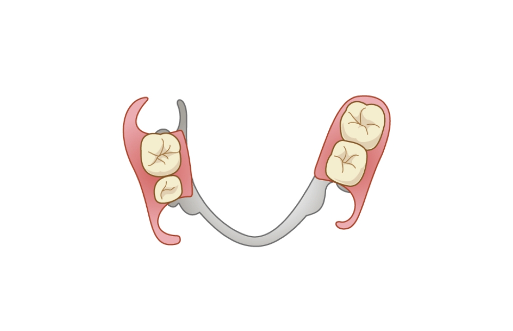 部分入れ歯