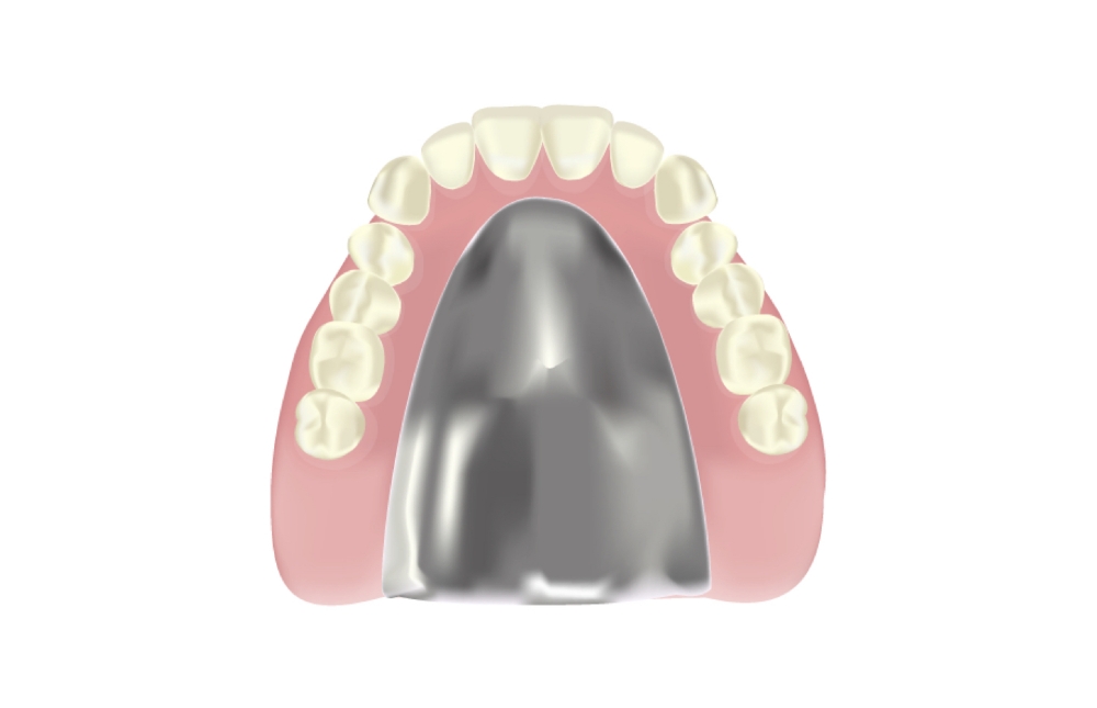 金属床義歯